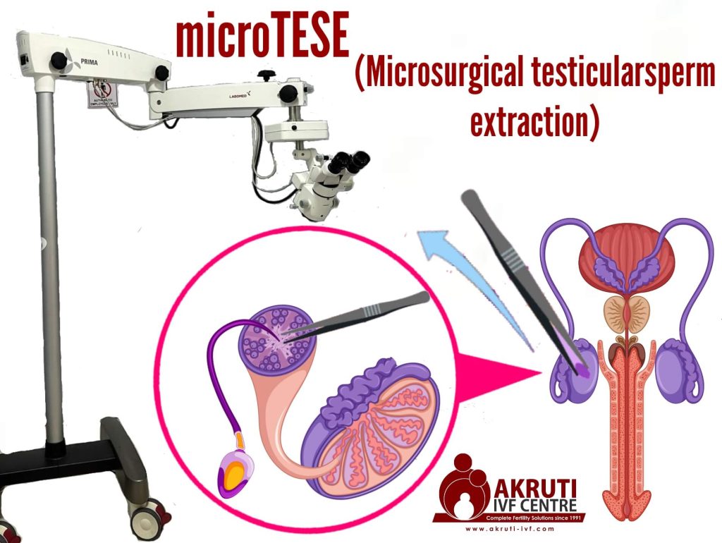 MicroTESE compressed