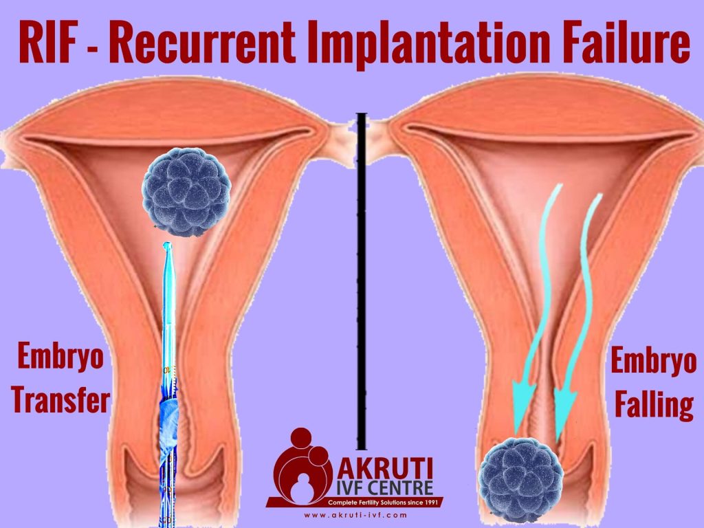 RIF Recurrent Implantation Failure 1